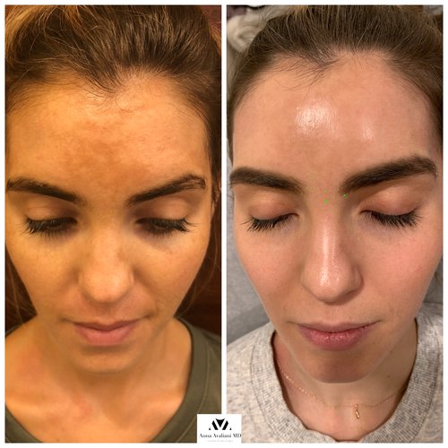 Picosure / Laser Skin Rejuvenation Before and After - IMG 8513