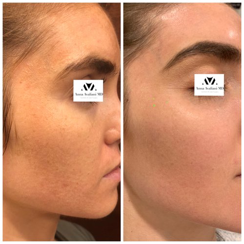 Picosure / Laser Skin Rejuvenation Before and After - IMG 8514