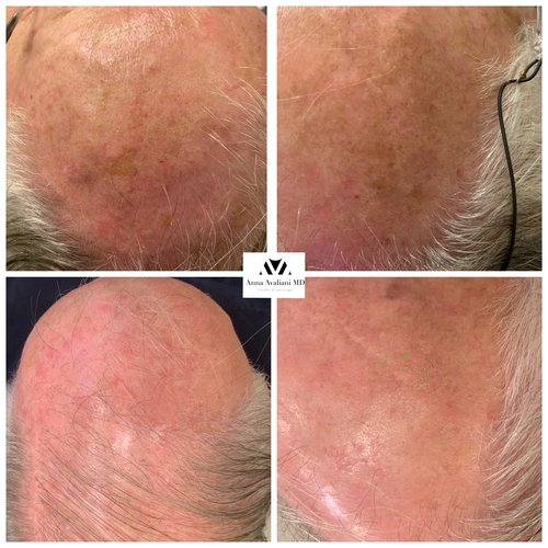 Picosure / Laser Skin Rejuvenation Before and After - IMG 8516