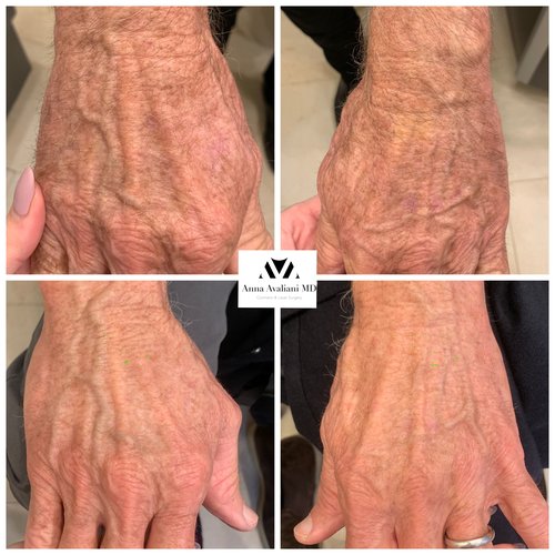 Picosure / Laser Skin Rejuvenation Before and After - IMG 8517