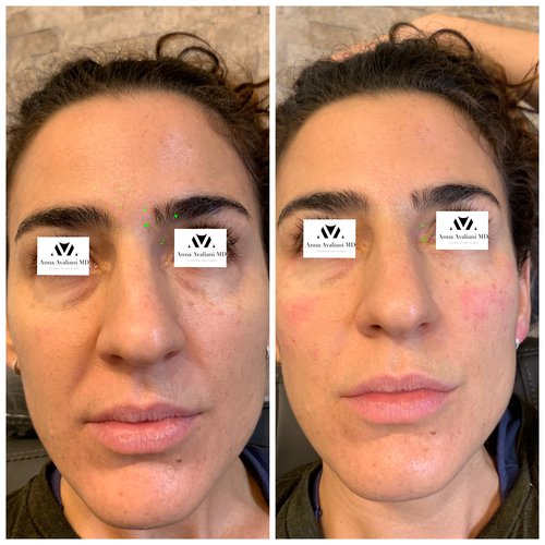 Fillers Before and After - IMG 8845