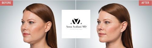 Kybella Before and After - K1