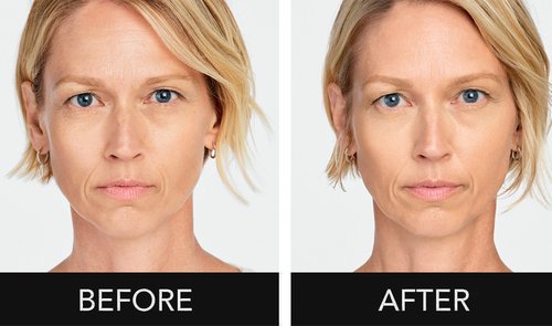 Radiesse Before and After - KG DCi7dXdFzPIQTbHbjlRcC15QPH6wMog.png