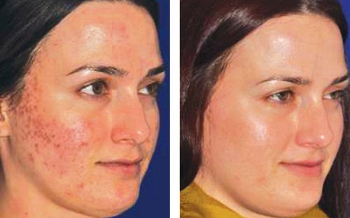 Microneedling Before and After - MP-ba-acne
