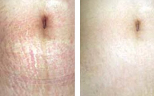 Microneedling Before and After - MP-ba-stretchmarks