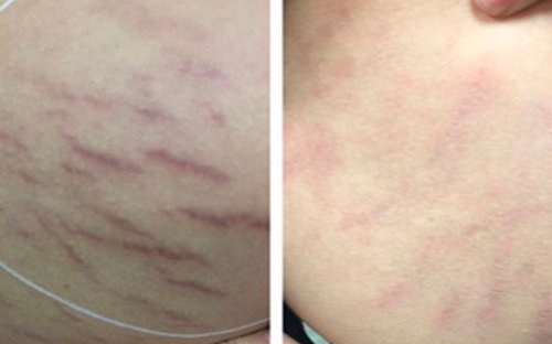 Microneedling Before and After - MPE BA DrSanders-3