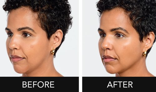 Radiesse Before and After - MmDdbFXQ-cQblwWfNrIwaq2Wh9SmWnumkg.png