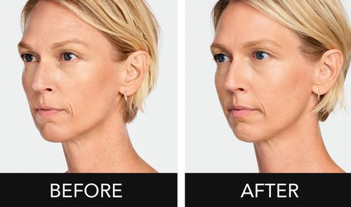 Radiesse Before and After - SEx5roFw1 D4vxC3s-BHImSbUYlAiHUCHg.png