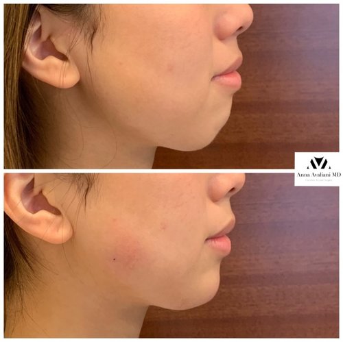 Non Surgical Chin Augmentation Before and After - UNADJUSTEDNONRAW thumb 12c02