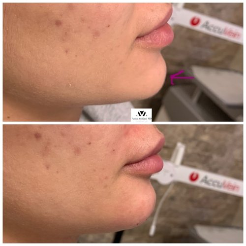 Non Surgical Chin Augmentation Before and After - UNADJUSTEDNONRAW thumb 14feb