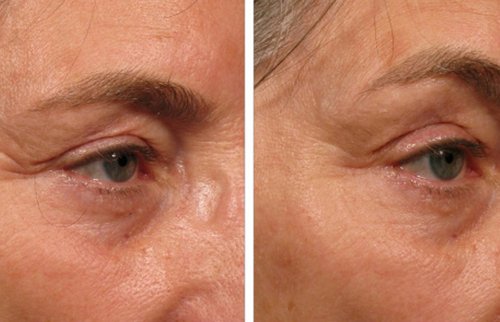 Ulthera Before and After - Ulthera1