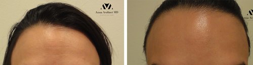 Botox Before and After - b1