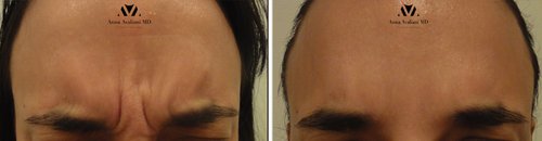 Botox Before and After - b11