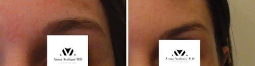 Botox Before and After - b12
