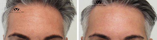 Botox Before and After - b2