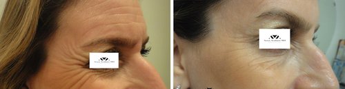 Botox Before and After - b3