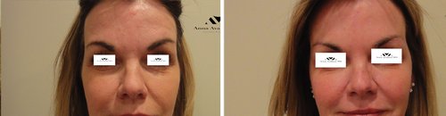 Botox Before and After - b4