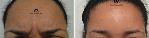 Botox Before and After - b5