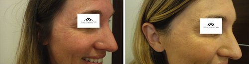 Botox Before and After - b8