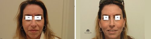 Botox Before and After - b9