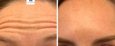 Botox Before and After