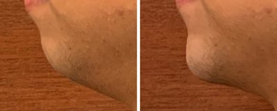 Non Surgical Chin Augmentation Before and After