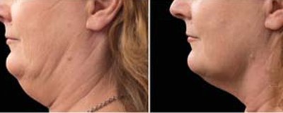 CoolSculpting Before and After