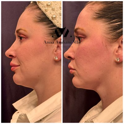 EmFace Before and After