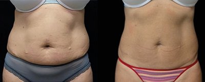 EMSCULPT Before and After