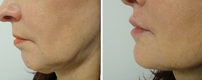 Face Threads Before and After