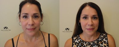 Fillers Before and After