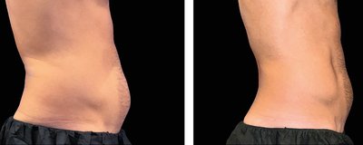 Emsculpt NEO Before and After