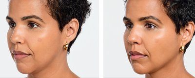 Radiesse Before and After