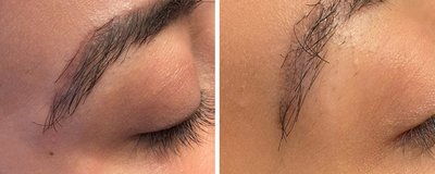 Tattoo Eyebrow Removal Before and After