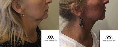 Kybella Before and After