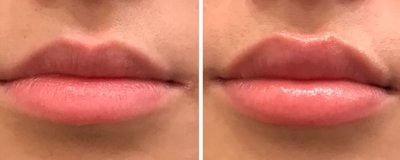Lip Augmentation Before and After