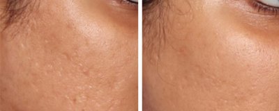 Microneedling Before and After