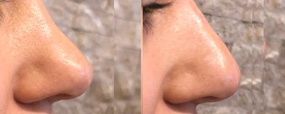 Non Surgical Nose Job Before and After