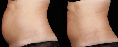 SculpSure Before and After