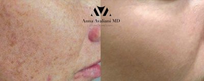 PicoSure / Laser Skin Rejuvenation Before and After