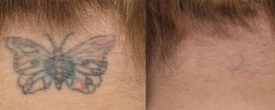 Tattoo Removal Before and After