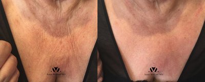 Ulthera Before and After