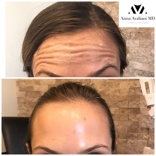 Botox Before and After - bbt1