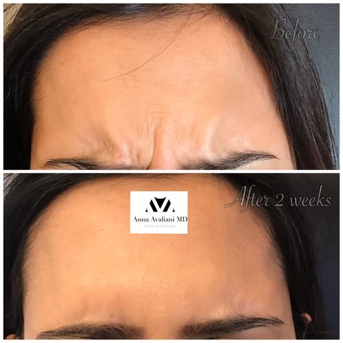 Botox Before and After - bbt10