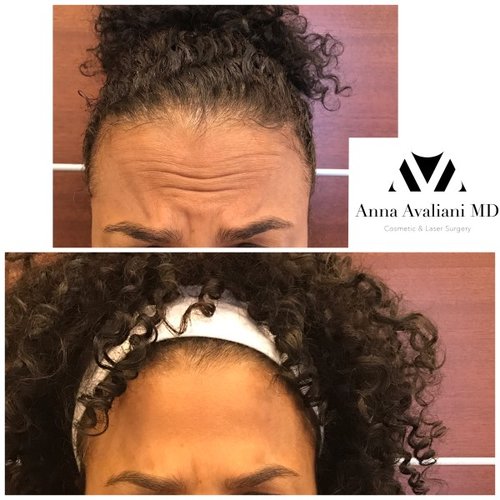 Botox Before and After - bbt2