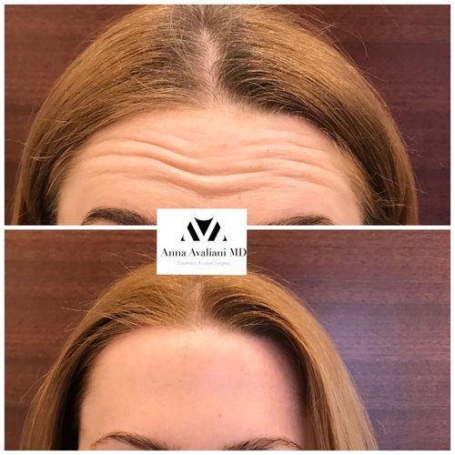 Botox Before and After - bbt3