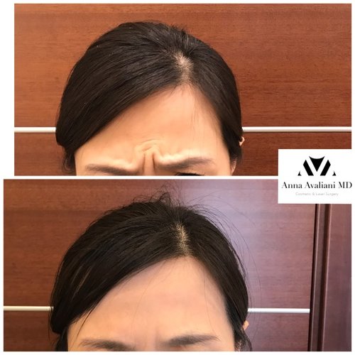 Botox Before and After - bbt4