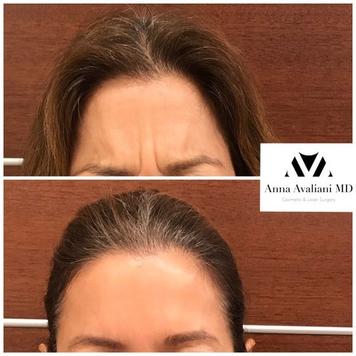 Botox Before and After - bbt6