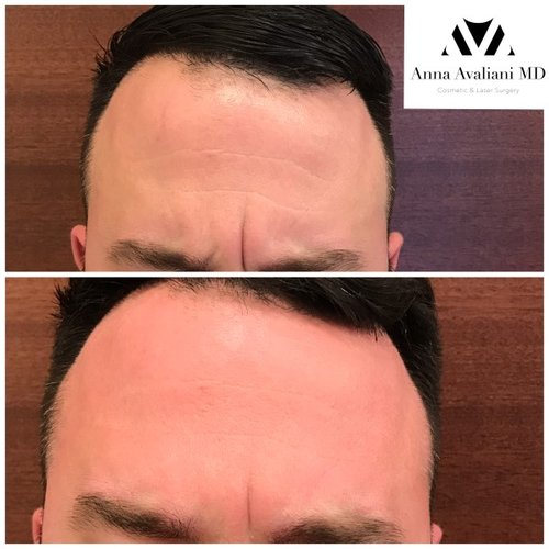 Botox Before and After - bbt7