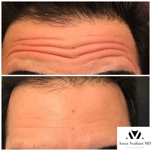 Botox Before and After - bbt8